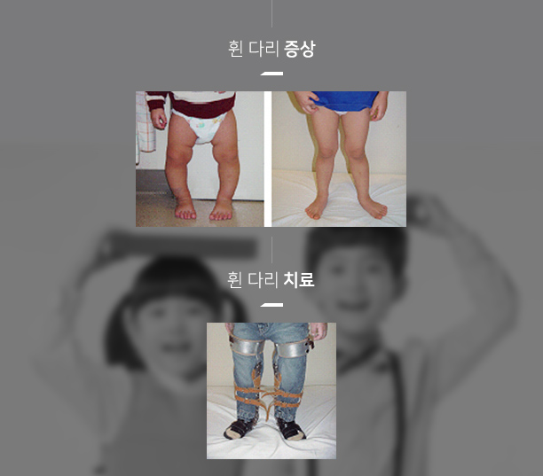 휜 다리증상 사진, 휜 다리 치료 사진